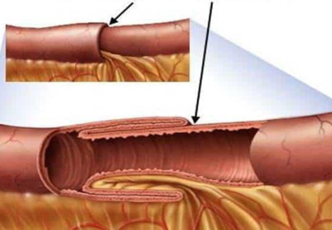 Các phương pháp điều trị lồng ruột